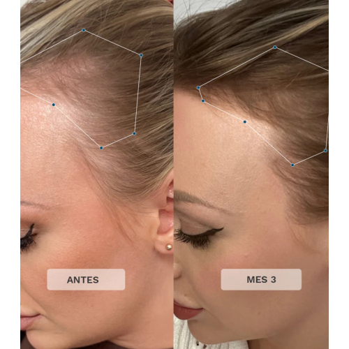 Hairburst - Vitamines capillaires Advance + Premium