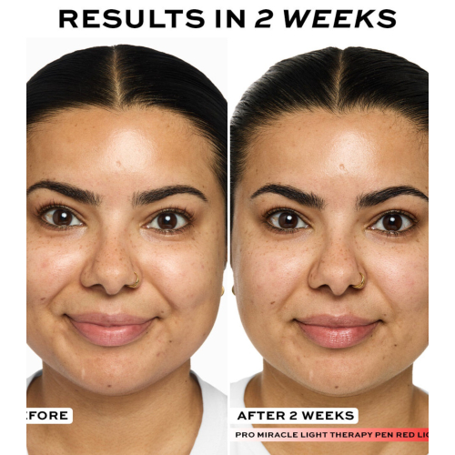 Revolution Pro - Appareil de photothérapie LED Pro Miracle