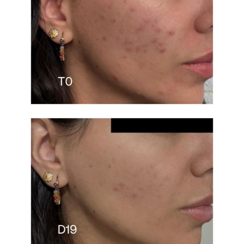Sensilis - *Oily Skin* - Concentré anti-imperfections Pure 15AZ